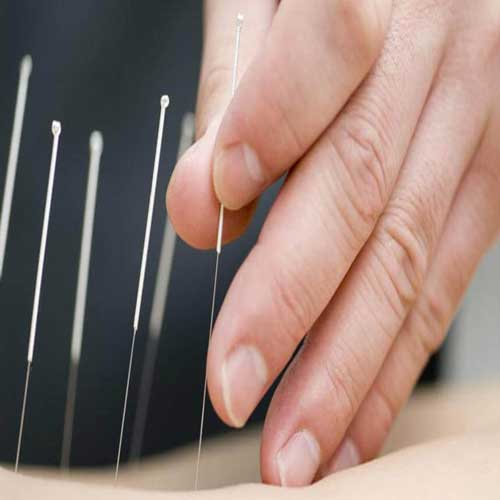 acupuncture-for-pinched-ner